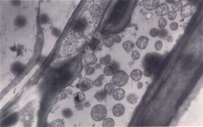 Several more or less spherical structures in the veins of the phloem are observed by electron microscopy. Phytoplasma causing stolbur 