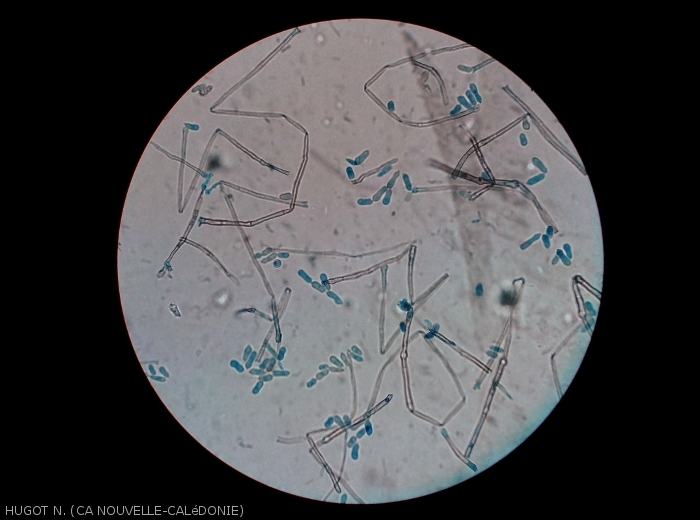 In this microscopic view of a sporulation of <i><b>Cladosporium colocasiae</i></b>, we notice the brown and septate conidiophores.